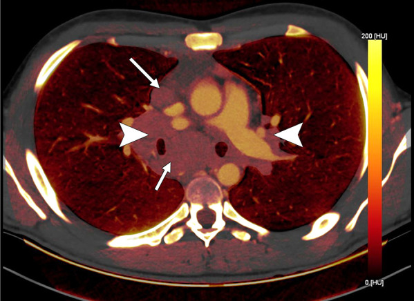 Lymph node characterization in a 16-year-old boy with lymphoma. The iodine-specific CT image shows increased iodine content within mediastinal nodes (arrows) and both hilar areas (arrowheads). The measured iodine content was 1.5 mg/mL.