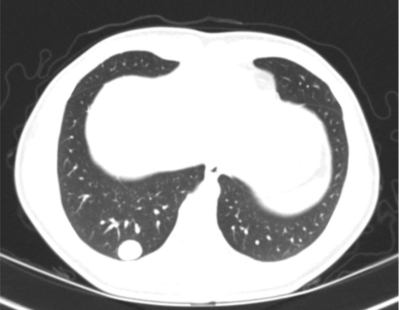 Malignant lung nodule in a 17-year-old girl with history of paraganglioma of the left neck. (a) Lung window CT image shows a well-defined right lower lobe nodule. (b) Axial iodine-specific CT image shows an iodine-containing right lower lobe nodule with an iodine density of 4.7 mg/mL. The nodule was surgically proven to be metastatic paraganglioma. Circles are ROIs on long nodule and aorta. App = application, CM = contrast material, Norm = normal, ROI = region of interest, Stddev = standard deviation, VNC = virtual noncontrast.