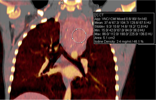 Treatment response in a 6-year-old girl with neuroblastoma. (a) Baseline iodine-specific CT image shows increased iodine content in a posterior mediastinal mass. Circle indicates region of interest over mediastinal mass. The iodine concentration was 2.4 mg/mL. (b) Iodine-specific CT image 4 months later shows decreased iodine content within the mass. Circle indicates region of interest over mediastinal mass. Findings are consistent with partial treatment response. Note that tumor size did not change between the two time points. Iodine 123 meta-iodobenzylguanidine study showed minimal residual metabolic activity and improved from baseline. App = application, CM = contrast material, Stddev = standard deviation, VNC = virtual noncontrast.