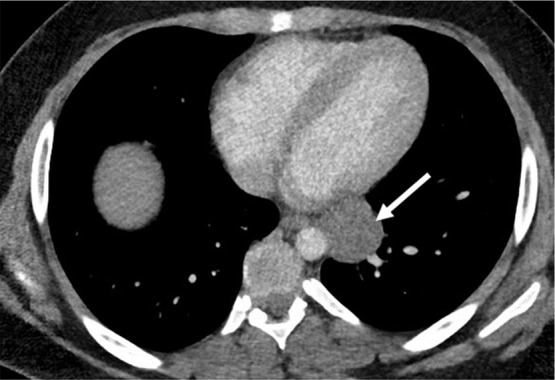 Mediastinal cyst characterization using iodine-specific CT images in a 13-year-old boy with a mediastinal mass detected at chest radiography. (a) Blended image demonstrates a fluid-filled middle mediastinal mass (arrow). The contents measured approximately 30 HU (attenuation slightly above water), suggesting a complex cyst. (b) Iodine-specific image shows absent iodine content confirming diagnosis of a cyst. The absence of iodine is based on comparison to chest wall musculature, which normally has no iodine content. Pathologically proven enteric duplication cyst.