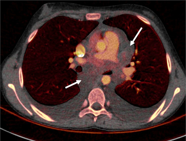 Inflammatory myofibroblastic tumor in a 15-year-old girl. Dual-energy CT iodine-specific image shows virtually no iodine content within this benign mediastinal lymphadenopathy (arrows). The iodine content was 0.4 mg/mL. Biopsy showed myofibroblastic and fibroblastic spindle cells with inflammatory infiltrate of lymphocytes and plasma cells consistent with myofibroblastic tumor.