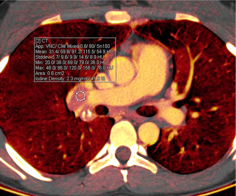 Treatment response in a 16-year-old girl with lymphoma. (a) Baseline iodine-specific CT image shows iodine content in a right hilar node. Circle indicates region of interest. The iodine concentration was 2.3 mg/mL. (b) Iodine-specific CT image 2 months later shows decreased iodine content. Circles indicate regions of interest within hilar node and pulmonary artery. The iodine concentration was 0.6 mg/mL. Findings are consistent with complete treatment response. Complete response confirmed at PET/CT. App = application, CM = contrast material, Stddev = standard deviation, VNC = virtual noncontrast.