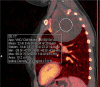 Benign mediastinal mass in a 16-year-old boy. (a) Coronal 40-keV CT image shows a posterior mediastinal mass. (b) Sagittal iodine-specific CT image shows trace iodine content, measured at 0.3 mg/mL. Circle indicates the region of interest. Note the iodine content in the mass is similar to that of muscle. Ganglioneuroma confirmed on surgical resection. App = application, CM = contrast material, Stddev = standard deviation, VNC = virtual noncontrast.