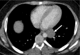 Mediastinal cyst characterization using iodine-specific CT images in a 13-year-old boy with a mediastinal mass detected at chest radiography. (a) Blended image demonstrates a fluid-filled middle mediastinal mass (arrow). The contents measured approximately 30 HU (attenuation slightly above water), suggesting a complex cyst. (b) Iodine-specific image shows absent iodine content confirming diagnosis of a cyst. The absence of iodine is based on comparison to chest wall musculature, which normally has no iodine content. Pathologically proven enteric duplication cyst.