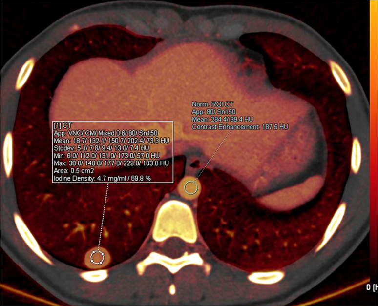 Malignant lung nodule in a 17-year-old girl with history of paraganglioma of the left neck. (a) Lung window CT image shows a well-defined right lower lobe nodule. (b) Axial iodine-specific CT image shows an iodine-containing right lower lobe nodule with an iodine density of 4.7 mg/mL. The nodule was surgically proven to be metastatic paraganglioma. Circles are ROIs on long nodule and aorta. App = application, CM = contrast material, Norm = normal, ROI = region of interest, Stddev = standard deviation, VNC = virtual noncontrast.