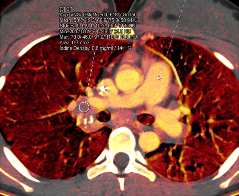 Treatment response in a 16-year-old girl with lymphoma. (a) Baseline iodine-specific CT image shows iodine content in a right hilar node. Circle indicates region of interest. The iodine concentration was 2.3 mg/mL. (b) Iodine-specific CT image 2 months later shows decreased iodine content. Circles indicate regions of interest within hilar node and pulmonary artery. The iodine concentration was 0.6 mg/mL. Findings are consistent with complete treatment response. Complete response confirmed at PET/CT. App = application, CM = contrast material, Stddev = standard deviation, VNC = virtual noncontrast.