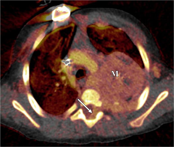 Neuroblastoma in a 1-year-old boy. (a) Axial iodine-specific CT image shows iodine content (2.8 mg/mL) within a posterior mediastinal mass (M), as well as iodine content within an area of intraspinal extension (arrow). The iodine content is greater than that of adjacent muscle. (b) Iodine-specific sagittal CT image shows the full extent of the intraspinal tumor extent (arrows).