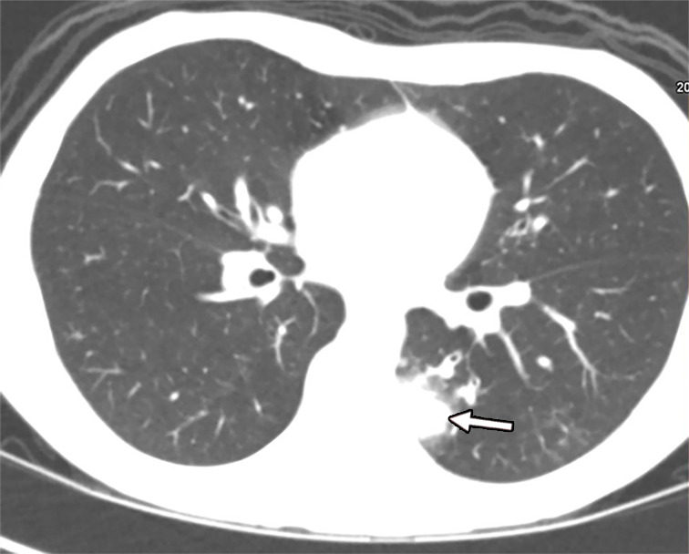 Fungal infection in a 15-year-old boy being treated for lymphoma. (a) Iodine-specific CT image shows iodine content within a left lower lobe nodule (arrow).The iodine concentration was 2.4 mg/mL. (b) Lung window CT image shows an ill-defined lung nodule with a surrounding halo (arrow). Biopsy yielded Aspergillus.