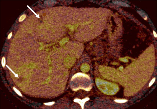 Liver metastases in a 10-year-old boy with desmoplastic small round cell tumor metastatic to chest and liver. (a) Blended CT image shows poorly defined hypoattenuating lesions in the right hepatic lobe (arrows). (b) Iodine-enhanced CT image increases lesion conspicuity and also shows some iodine content within the lesion (arrows).