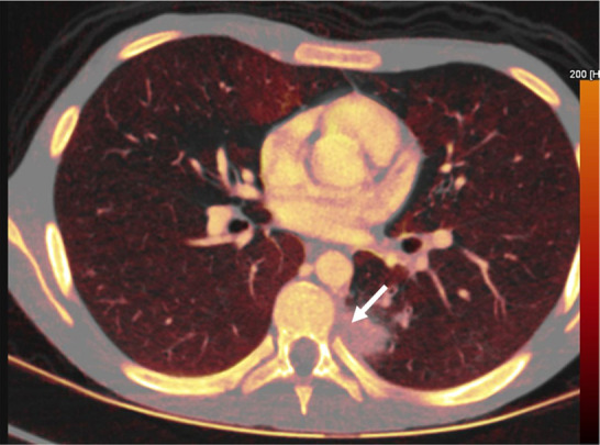 Fungal infection in a 15-year-old boy being treated for lymphoma. (a) Iodine-specific CT image shows iodine content within a left lower lobe nodule (arrow).The iodine concentration was 2.4 mg/mL. (b) Lung window CT image shows an ill-defined lung nodule with a surrounding halo (arrow). Biopsy yielded Aspergillus.