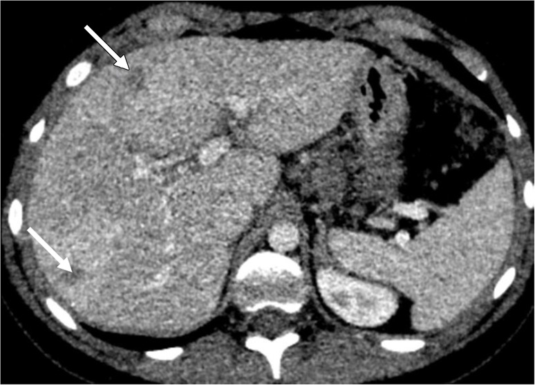 Liver metastases in a 10-year-old boy with desmoplastic small round cell tumor metastatic to chest and liver. (a) Blended CT image shows poorly defined hypoattenuating lesions in the right hepatic lobe (arrows). (b) Iodine-enhanced CT image increases lesion conspicuity and also shows some iodine content within the lesion (arrows).