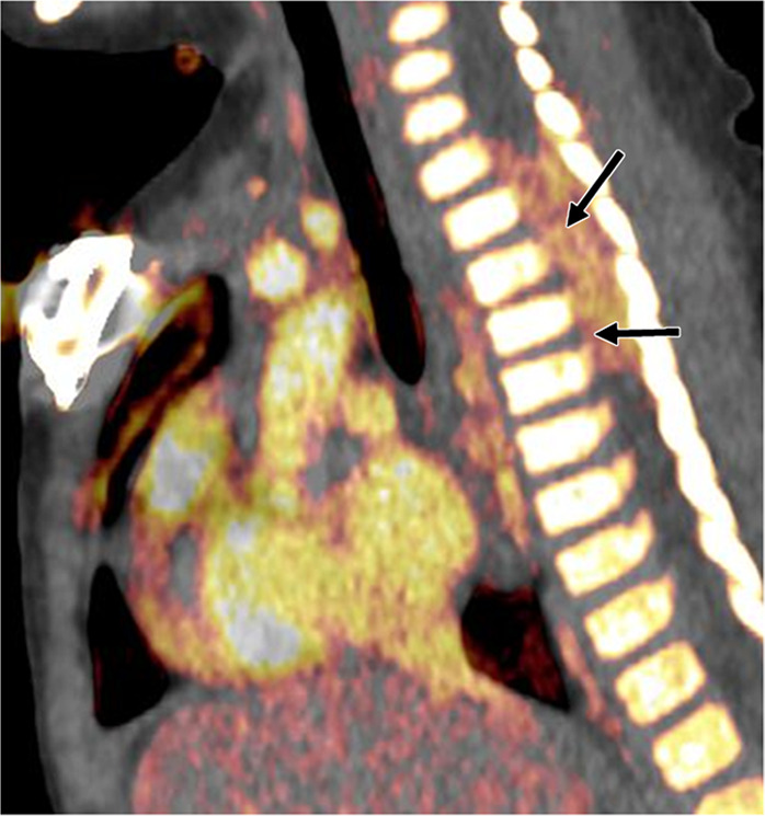 Neuroblastoma in a 1-year-old boy. (a) Axial iodine-specific CT image shows iodine content (2.8 mg/mL) within a posterior mediastinal mass (M), as well as iodine content within an area of intraspinal extension (arrow). The iodine content is greater than that of adjacent muscle. (b) Iodine-specific sagittal CT image shows the full extent of the intraspinal tumor extent (arrows).