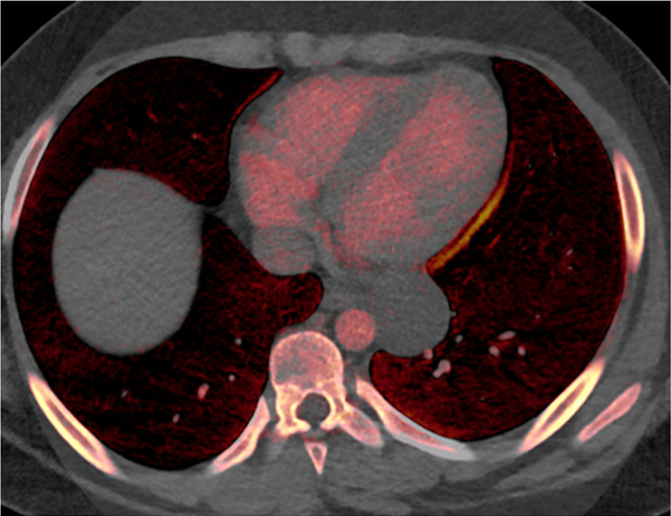 Mediastinal cyst characterization using iodine-specific CT images in a 13-year-old boy with a mediastinal mass detected at chest radiography. (a) Blended image demonstrates a fluid-filled middle mediastinal mass (arrow). The contents measured approximately 30 HU (attenuation slightly above water), suggesting a complex cyst. (b) Iodine-specific image shows absent iodine content confirming diagnosis of a cyst. The absence of iodine is based on comparison to chest wall musculature, which normally has no iodine content. Pathologically proven enteric duplication cyst.