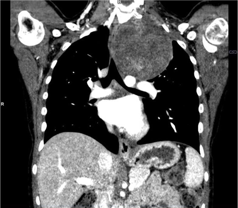 Benign mediastinal mass in a 16-year-old boy. (a) Coronal 40-keV CT image shows a posterior mediastinal mass. (b) Sagittal iodine-specific CT image shows trace iodine content, measured at 0.3 mg/mL. Circle indicates the region of interest. Note the iodine content in the mass is similar to that of muscle. Ganglioneuroma confirmed on surgical resection. App = application, CM = contrast material, Stddev = standard deviation, VNC = virtual noncontrast.