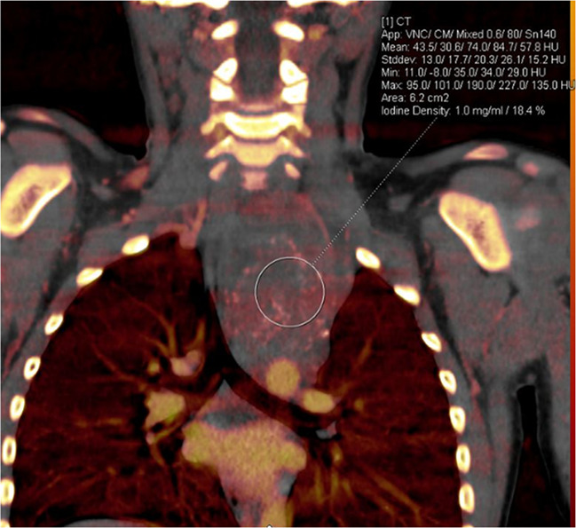 Treatment response in a 6-year-old girl with neuroblastoma. (a) Baseline iodine-specific CT image shows increased iodine content in a posterior mediastinal mass. Circle indicates region of interest over mediastinal mass. The iodine concentration was 2.4 mg/mL. (b) Iodine-specific CT image 4 months later shows decreased iodine content within the mass. Circle indicates region of interest over mediastinal mass. Findings are consistent with partial treatment response. Note that tumor size did not change between the two time points. Iodine 123 meta-iodobenzylguanidine study showed minimal residual metabolic activity and improved from baseline. App = application, CM = contrast material, Stddev = standard deviation, VNC = virtual noncontrast.