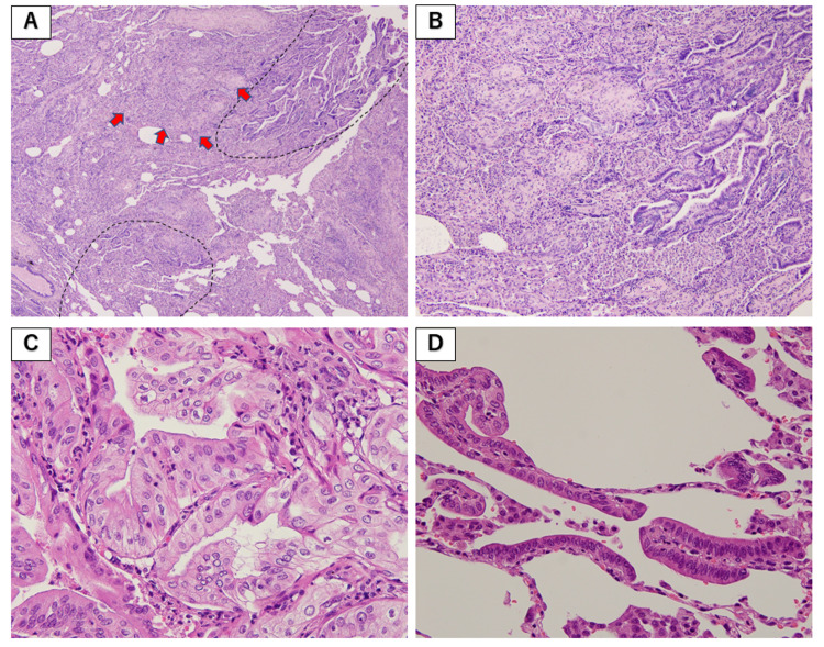 Idiopathic Pulmonary Fibrosis Complicated By Adenocarcinoma And