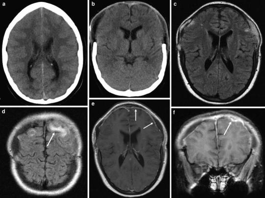 Inflammatory Diseases of the Meninges - PMC