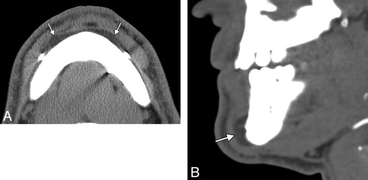 Fig 11.