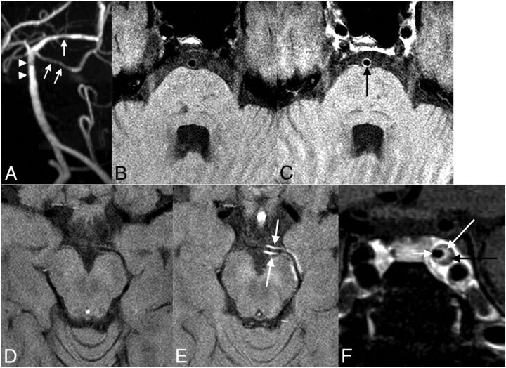 Intracranial Vessel Wall MRI: Principles and Expert Consensus ...