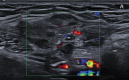 Ultrasound shows an mildly heterogeneous, hypoechoic mass with vascularity; T1-weighted fat suppressed image shows an isointense area in the left inguinal region; Same region as in Figure 1b, after intravenous administration of gadolinium, showing vivid lesional enhancement