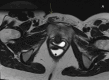 Axial T2‑weighted image shows a hypointense area in the right inguinal region with hyperintense foci. The mass is adjacent to the extrapelvic portion of the right round uterine ligament in the inguinal canal; Sagittal T2-weighted image of the same area as Figure 2b; Axial T1-weighted image with fat suppression shows the lesion with an isointense signal and discrete T1 hyperintense foci