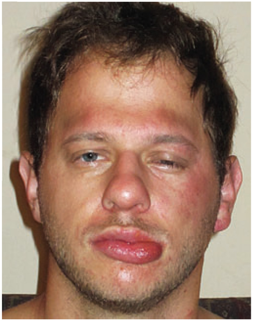 Mango contact allergy pmc