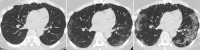 Images in a 55-year-old woman with pulmonary alveolar proteinosis
recurrence. Axial CT lung window images at (A) 2 months, (B) 1 year, and (C)
2 years after lung transplantation show increasing patchy ground-glass
opacities and septal thickening (crazy paving) compatible with recurrence of
pulmonary alveolar proteinosis.