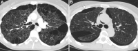 Images in a 32-year-old woman with lymphangioleiomyomatosis
recurrence. (A) Axial CT image shows multiple small thin-walled cysts and
larger subpleural bulla in a pretransplant patient with
lymphangioleiomyomatosis. There is a small right pneumothorax (arrow). (B)
Axial CT image obtained 7 years after bilateral lung transplantation shows
multiple small bilateral thin-walled cysts and trace right pneumothorax
(arrow) compatible with lymphangioleiomyomatosis recurrence. There is also
small pneumomediastinum.