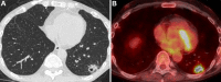 Images in a 57-year-old man with adenocarcinoma of the lung allograft
16 years after bilateral lung transplantation for idiopathic pulmonary
fibrosis. (A) Axial CT image shows a left lower lobe spiculated nodule with
central cavitation, and (B) axial fluorodeoxyglucose PET/CT image shows
intense fluorodeoxyglucose uptake of the nodule. Biopsy proved primary
adenocarcinoma of the lung.