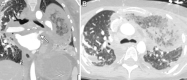 Images in a 49-year-old man with left pulmonary vein stenosis
identified 1 week after bilateral lung transplantation for cystic fibrosis.
(A) Coronal chest CT bone window image shows stenosis of the left upper lobe
pulmonary vein (arrow), and (B) axial chest CT image shows left upper lobe
consolidation and ground-glass opacities due to pulmonary venous congestion
and likely venous infarction.