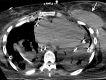 Image in a 62-year-old woman with chest wall hematoma 2 weeks after
bilateral lung transplantation for interstitial lung disease. Axial chest CT
image shows fluid collection in the soft tissues of the left chest wall,
measuring 45 HU on average, consistent with chest wall hematoma. Hematoma
resolved in 2 weeks after surgical drain placement.