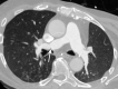 Image in a 58-year-old man with pulmonary artery stenosis identified
at the first postoperative CT performed after bilateral lung transplantation
for interstitial lung disease. Three-dimensional reconstructed axial chest
CT image shows stenosis of the right main pulmonary artery (arrow) with
relative lucency and hypovascularity of the right lung in the setting of
right main pulmonary artery stenosis.
