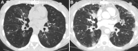 Images in a 35-year-old man with acute cellular rejection after
bilateral lung transplantation for cystic fibrosis. (A) Axial chest CT lung
window image 2 years and 7 months after transplantation shows bilateral
ground-glass opacities. (B) Axial chest CT lung window image 2 years and 8
months after transplantation shows increased mixed-attenuation nodular
opacities.