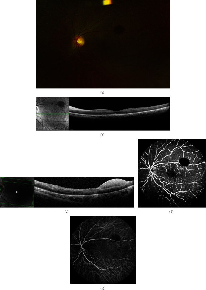 Valsalva Retinopathy Presenting as Subretinal Hemorrhage - PMC