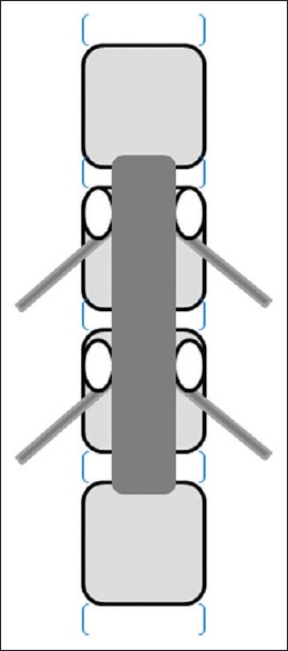 Safety and efficacy of spinal loop rectangle and sublaminar wires for ...