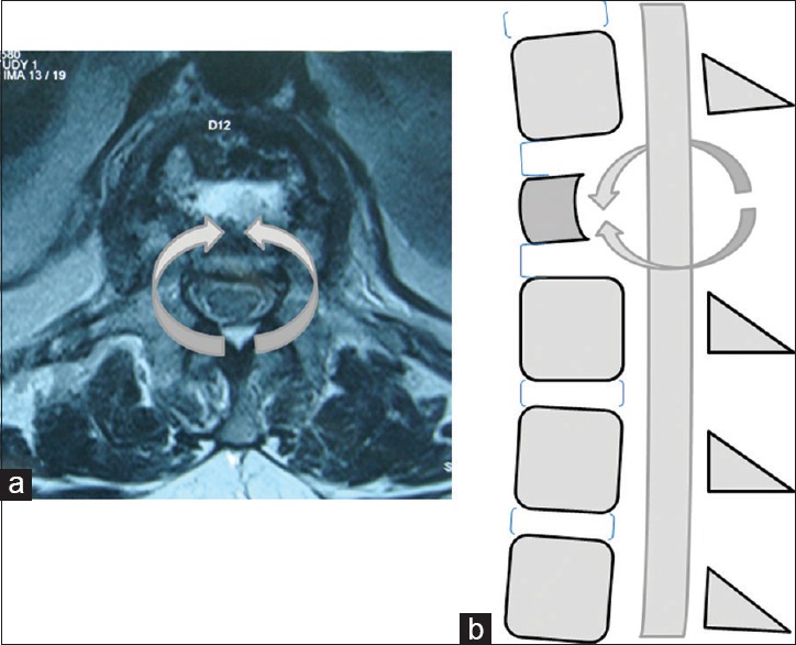 Safety and efficacy of spinal loop rectangle and sublaminar wires for ...