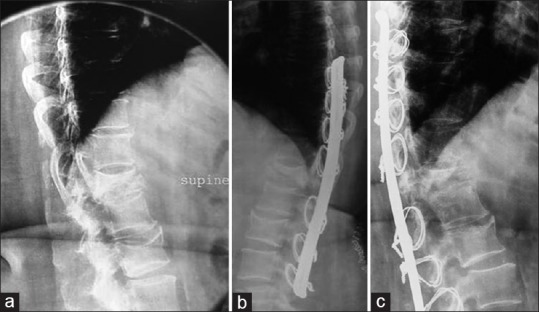 Safety and efficacy of spinal loop rectangle and sublaminar wires for ...