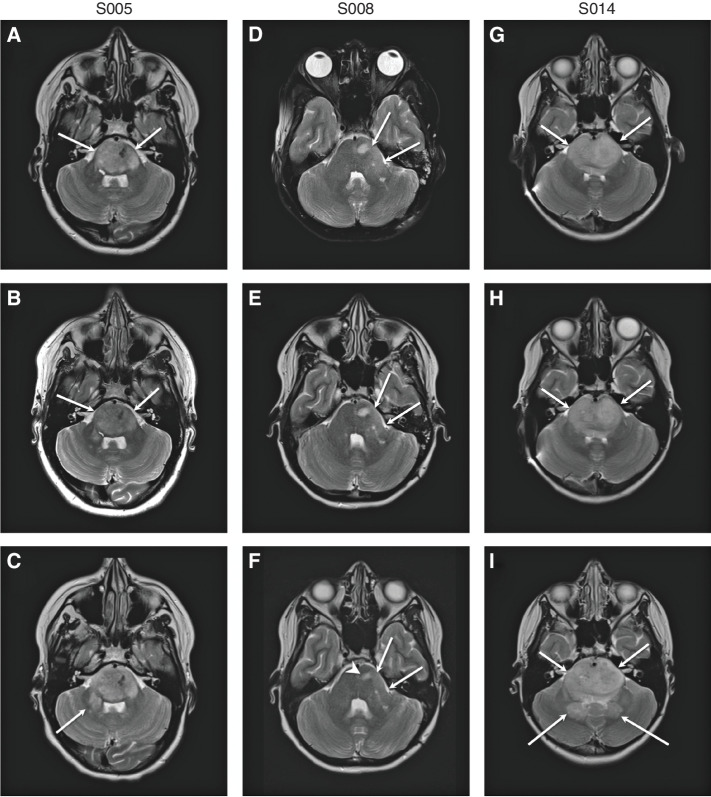 Figure 3. Neuroimaging after locoregional B7-H3 CAR T-cell infusion. MRI images from S005 (A–C), S008 (D–F), and S014 (G–I). Axial T2-weighted images from all three patients immediately before initial CAR T-cell administration (A, D, and G), following course 2 (i.e., 4 intracranial B7-H3 CAR T-cell infusions; B, E, and H), and prior to any other tumor-directed therapy (C, F, and I). Images correspond to study participants S005 (A–C; imaged at days −2, 53, and 138 relative to first infusion), S008 (D–F; imaged at days −19, 50, and 307 relative to first infusion), and S014 (G–I; imaged at days −1, 45, and 211 relative to first infusion). Patients S005 and S014 experienced slow progression in tumor bulk over time, with increased tumor infiltration in the right brachium pontis (arrow in C) and dentate nuclei (posterior arrows in I). Patient S008 showed mildly decreased tumor bulk (long arrows in F) and decreased conspicuity of T2 hyperintense tumoral nodule (short arrowhead in F).