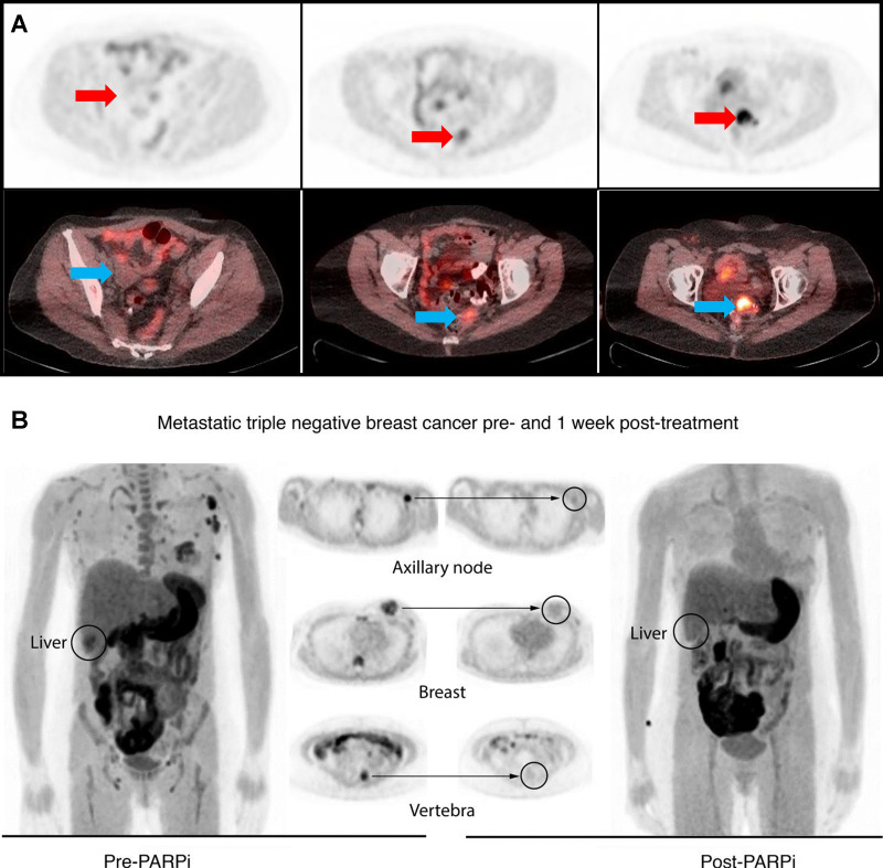 Clinical PET/CT imaging studies in patients with (A) ovarian and (B) breast cancer. (A) The standardized uptake value (SUV) measurements of 18F fluorthanatrace (18F-FTT) in patients with ovarian cancer (n = 20 women; age range, 22–68 years; median, 60 years) varied greatly, from 2 (background) to 12 (highest). Arrows indicate the site of disease. This is the representation of three images from patients with low, medium, and high uptake. (B) In a follow-up breast cancer trial, four patients (age range, 41–71 years; median age, 52 years) with stage III or IV disease and receiving poly (adenosine diphosphate–ribose) polymerase inhibitor (PARPi) therapy were enrolled. Three of the tumors were triple negative and one was estrogen positive. The initial SUV was moderate, 4.2–6.8, at baseline (left). After 1 week of PARPi treatment, the participants were scanned with 18F-FTT again. The uptake of 18F-FTT was diminished after the PARPi treatment. (Data reproduced from references 16 and 31.) (B reprinted, with permission, from reference 16.)