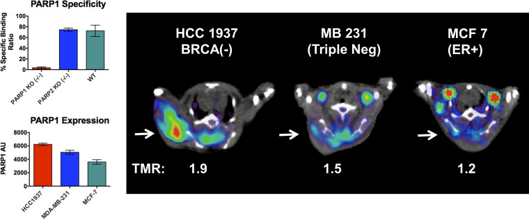 In vitro and in vivo studies demonstrate the ability of the analog of 18F fluorthanatrace (18F-FTT), 125I-KX1, to provide a measurement of poly (adenosine diphosphate–ribose) polymerase-1 (PARP-1) expression levels in tumor cells or a solid tumor. In vitro cell uptake study was performed using MEF PARP-1 KO−/−, MEF PAR2 KO −/−, and MEF wild-type cell. The cells were incubated with 125I-KX1, and the uptake was abrogated by the knockout of PARP-1 activity, shown in the top left. 125I-KX1 uptake was not decreased in the wild-type and the PARP-2 knockout cell line, showing the specificity of the 18F-FTT uptake to PARP-1 expression. PARP-1 activity was measured in three different cell lines, HCC1937 (BRCA mutation), MD-MBA-231 (triple negative), and MCF (ER positive). In vivo studies using xenografts implanted with three different cell lines revealed that the uptake of 125I-KX1, as shown in tumor to muscle ratio (TMR), paralleled the expression levels of PARP-1 in these cells. AU = arbitrary unit, BRCA = breast cancer gene, ER = estrogen receptor, KO = knockout, MEF = mouse embryonic fibroblast.