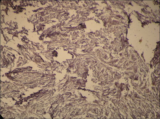 Plexiform Neurofibromatosis Involving Face And Oral Cavity - Pmc