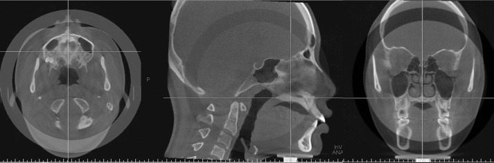 Figure 2. Reorientation of CBCT scans: reoriented as perpendicular to midpalatal suture (axial section, x-plane), parallel to palatal plane (sagittal section, y-plane), and tangent to nasal floor at its most inferior level, where both of the palatal roots of the maxillary first molars are shown (coronal section, z-plane).