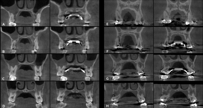 Figure 6. The examples of rapid maxillary expansion with bone-borne (A–D) and tooth-borne (E–H) expanders, compared between pretreatment period and after expansion at the first premolar (A and E), the second premolar (B and F), the first molar (C and G), and the second molar (D and H).