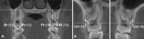 Figure 5. (A) Vertical dental heights from NF to mesiobuccal cusp (Br, right side; Bl, left side) or mesiopalatal cusp (Pr, right side; Pl, left side); (B) Alveolar bone dehiscence measured from the cemento-enamel junction (CEJ) to the alveolar crest on buccal side. Crr indicates right side; Crl, left side.