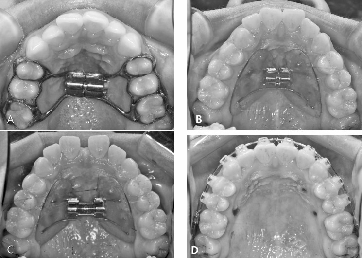 Figure 1. Expander design used in the study: tooth-borne (A) and bone-borne (B). Intraoral photos after expansion (C) and 1 week after removal of C-expander in bone-borne group (D).