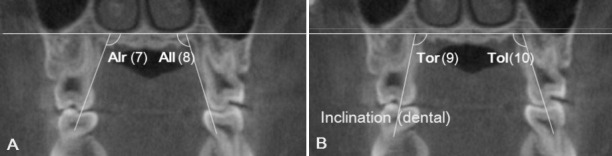 Figure 4. Alveolar bone inclination (A) (between the palatal alveolar slop and NF. Alr, right side; All, left side) and tooth inclination (B) (between the palatal root axis and NF. Tor, right side; Tol, left side).