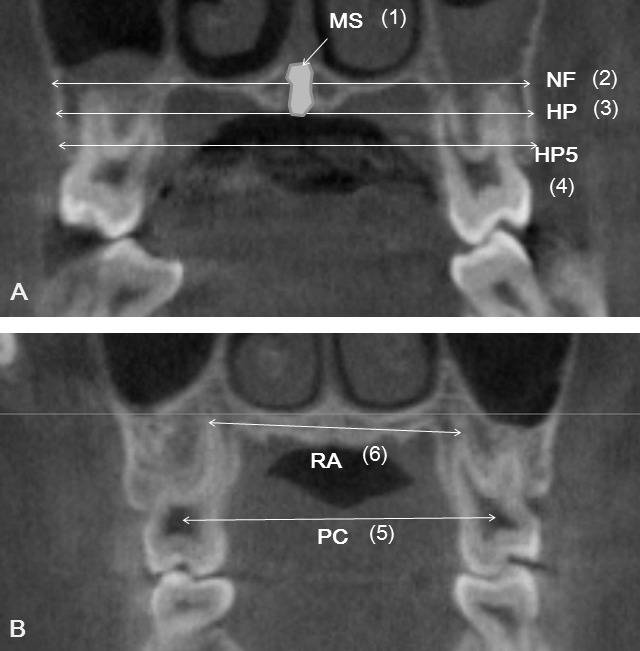 Figure 3. Definition of measurements. Skeletal (A) and dental (B) transverse distances. NF indicates maxillary width tangent to the nasal floor at its most inferior level; HP, maxillary width tangent to the hard palate at the most inferior level; HP5, maxillary width parallel to the line NF and 5 mm below the line HP; MS, area of midpalatal suture; RA, distance between palatal root apices; and PC, distance between pulp chambers.