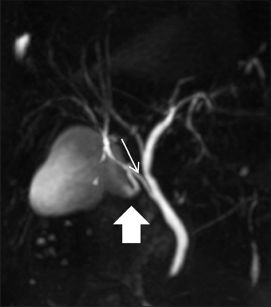 Magnetic Resonance Cholangiographic Evaluation Of Intrahepatic And