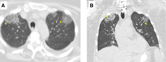 Mixed cryoglobulinaemic vasculitis with pulmonary infiltrates and ...