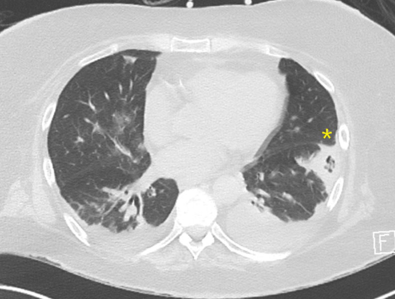 Mixed cryoglobulinaemic vasculitis with pulmonary infiltrates and ...